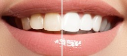 Teeth Whitening Dental Clinic in Istanbul Turkey